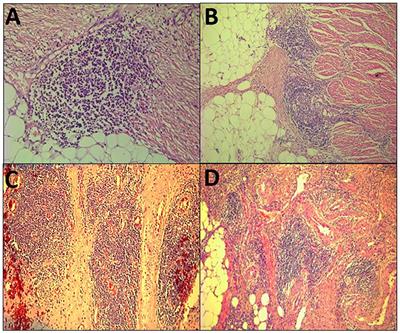 The Crohn's-Like Lymphoid Reaction to Colorectal Cancer-Tertiary Lymphoid Structures With Immunologic and Potentially Therapeutic Relevance in Colorectal Cancer